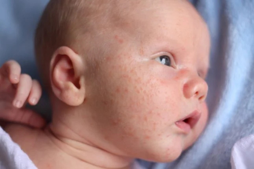 Boutons de chaleur : comment apaiser la peau des petits et des grands cet été ?